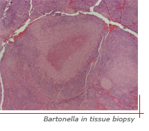 photo of Bartonella in tissue biopsy