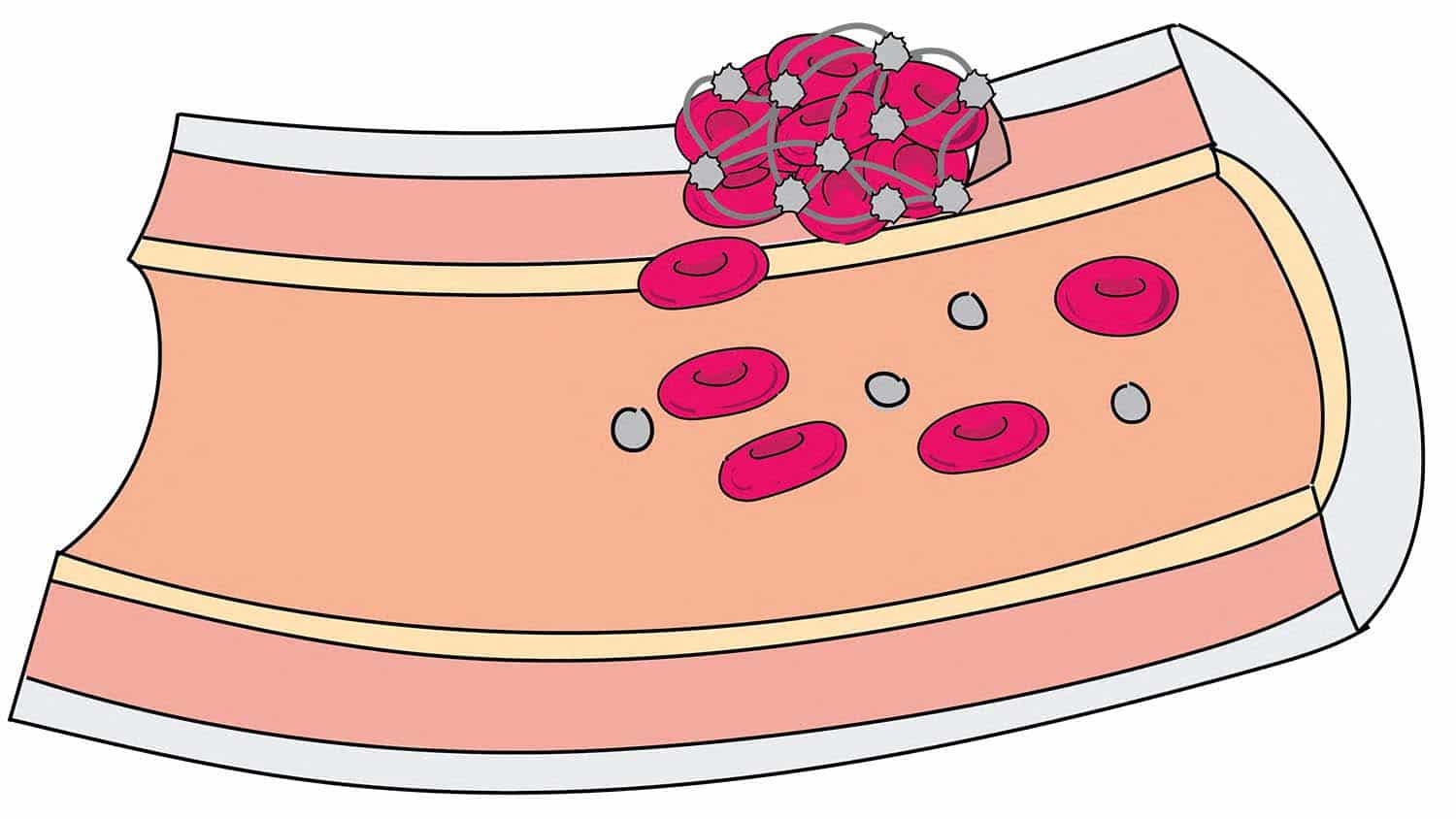 illustration shows platelets (white blobs) and red blood cells clotting at the site of a puncture in a blood vessel.